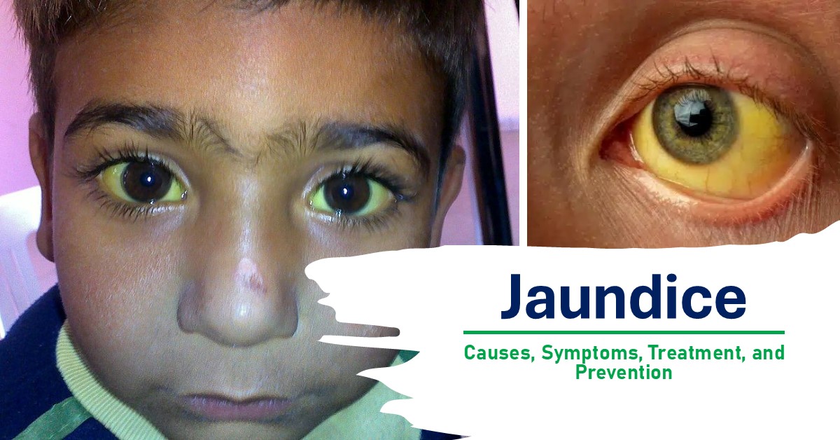 Jaundice: Causes, Symptoms, Treatment, and Prevention